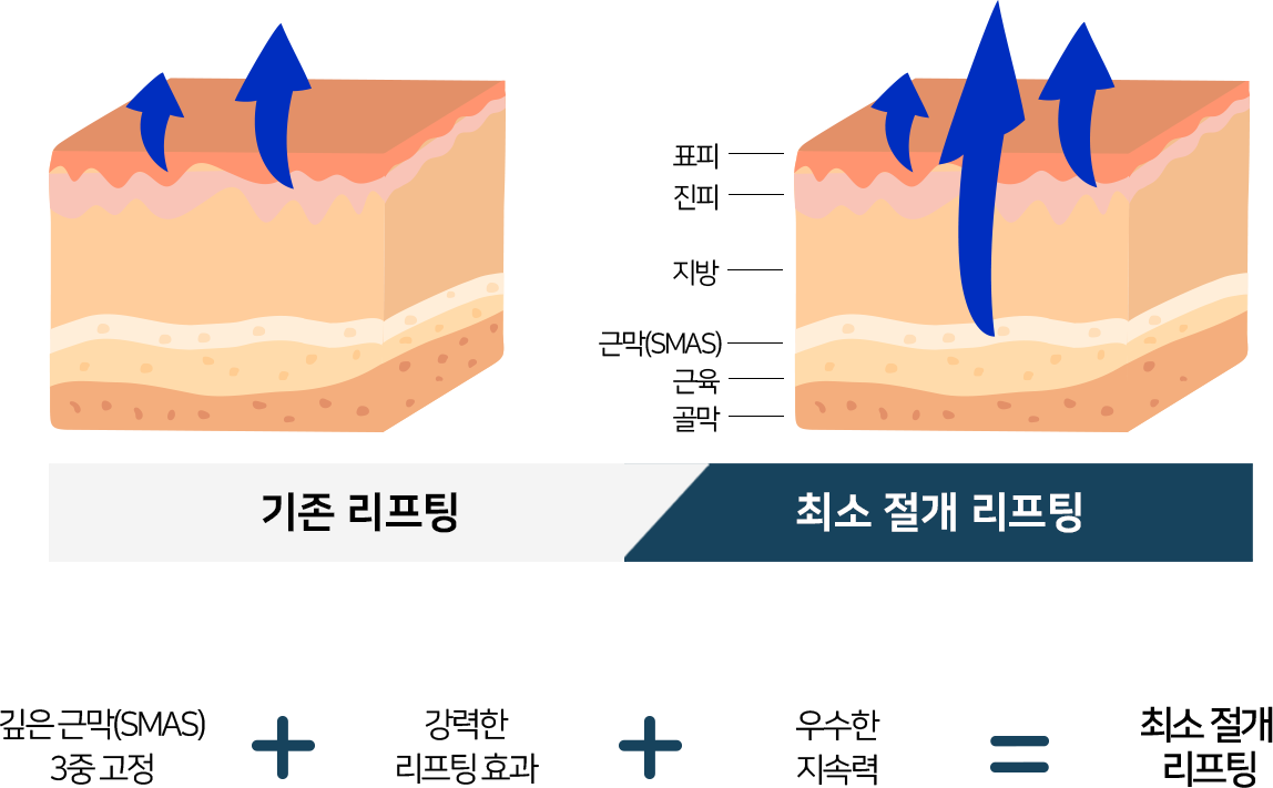 최소절개리프팅